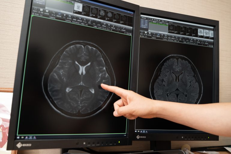 MRI検査によって分かる疾患｜盛岡市でMRI検査なら、まさと脳神経内科クリニック