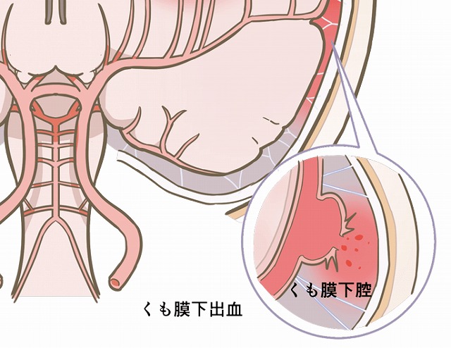 くも膜下出血｜盛岡市まさと脳神経内科クリニック