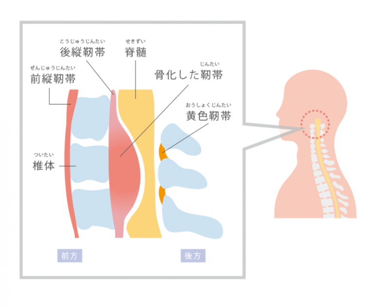 頸椎後縦靱帯骨化症｜盛岡市まさと脳神経内科クリニック